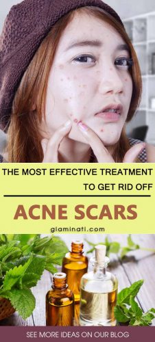 Acne Scar Treatment