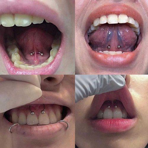 Tongue Web Piercing Infection