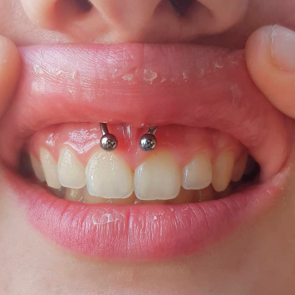 Smiley Piercing Infection
