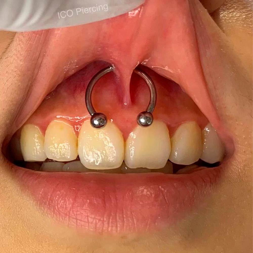 Smiley Piercing Infection